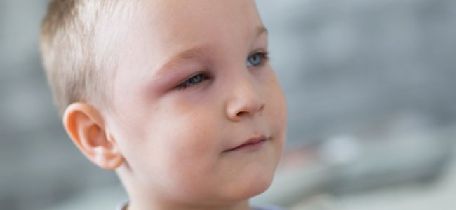 remédios-naturais-contra-o-terçol-crianças A remédios-naturais-contra-o-terçol-crianças A