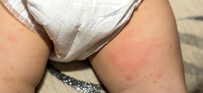 Assaduras nos bebês Assaduras nos bebês