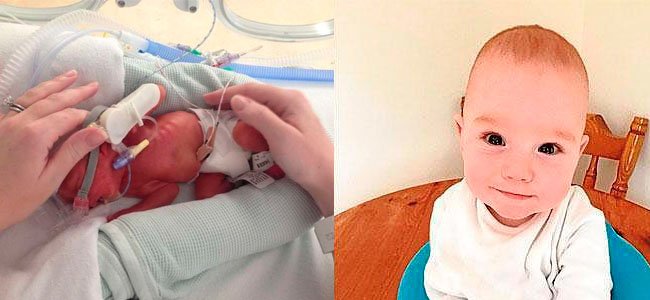 O Bebe Mais Prematuro Do Mundo Antes E Depois