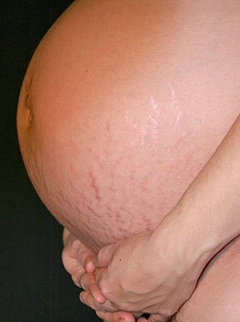 Como evitar las estrías durante a gravidez