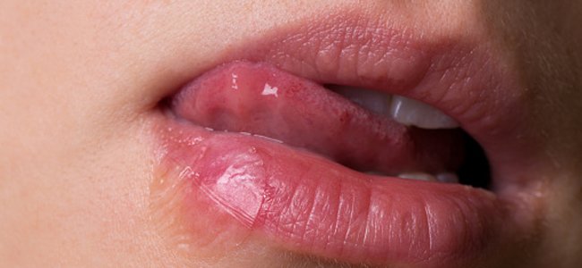 herpes-labial-durante-a-gravidez A