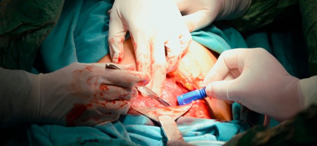 resolução-para-diminuir-número-cesáreas A